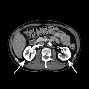 Kidneys CT scan