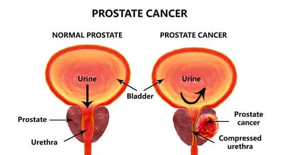 ProstateCancer