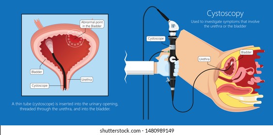 Cystoscopy Tennessee Valley Urology Center